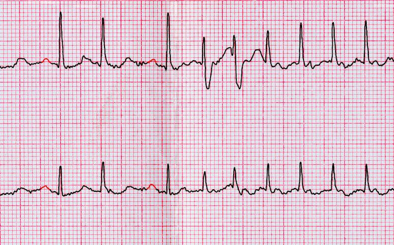 The Causes and Consequences of AFib