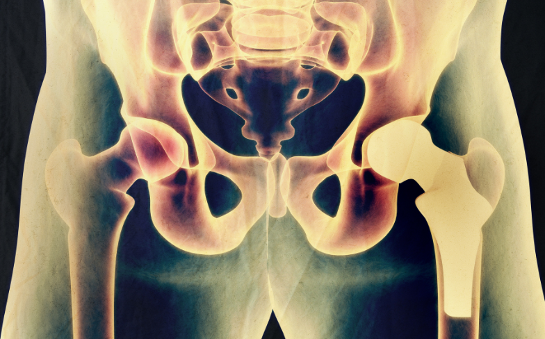 Why Choose Anterior Hip Replacement?