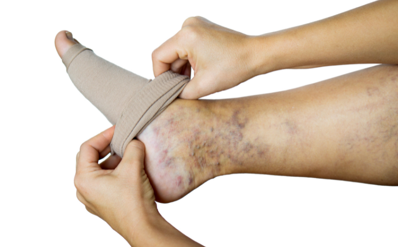 Medical Treatment for Varicose Veins
