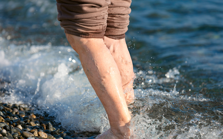 Unveiling the Truth About Varicose Veins: Top Myths Debunked
