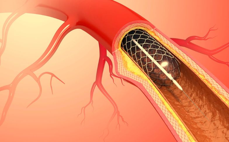 What Is Heart Catheterization?