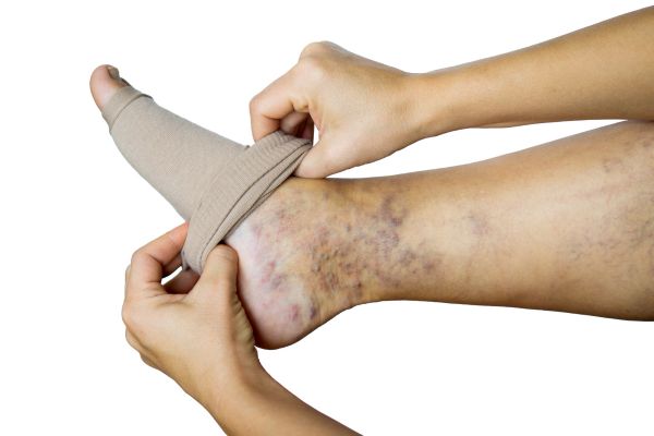 persons foot with venous ulcers