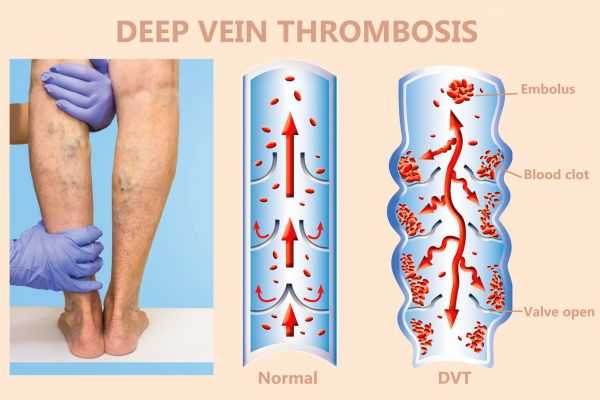 diagram of deep vein thrombosis
