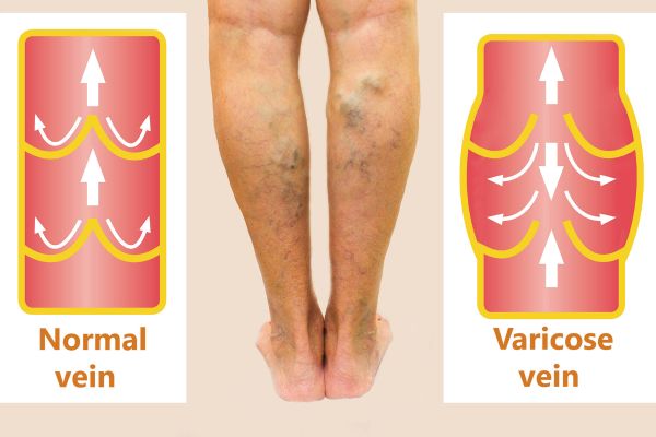 diagram of varicose veins